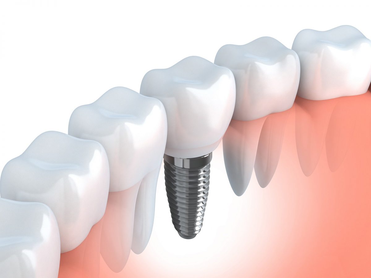 歯周病認定医によるインプラント治療のイメージ