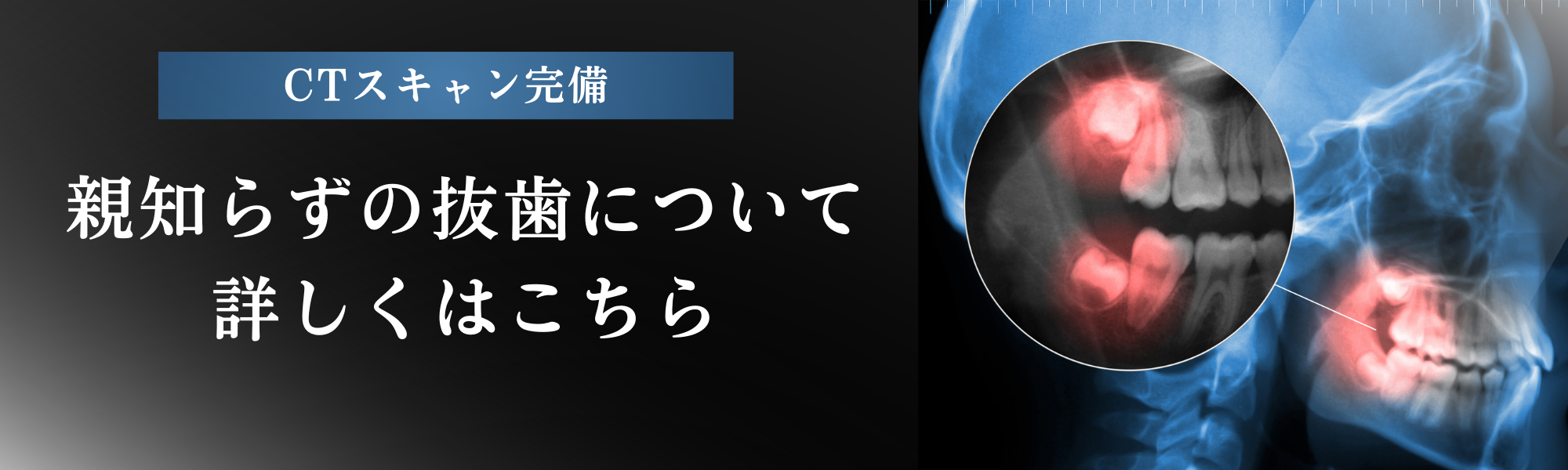 親知らず治療