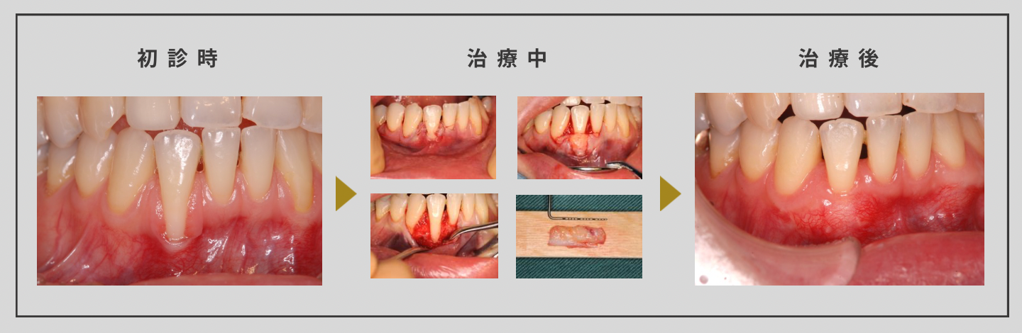 矯正後に歯茎が下がってしまった方
