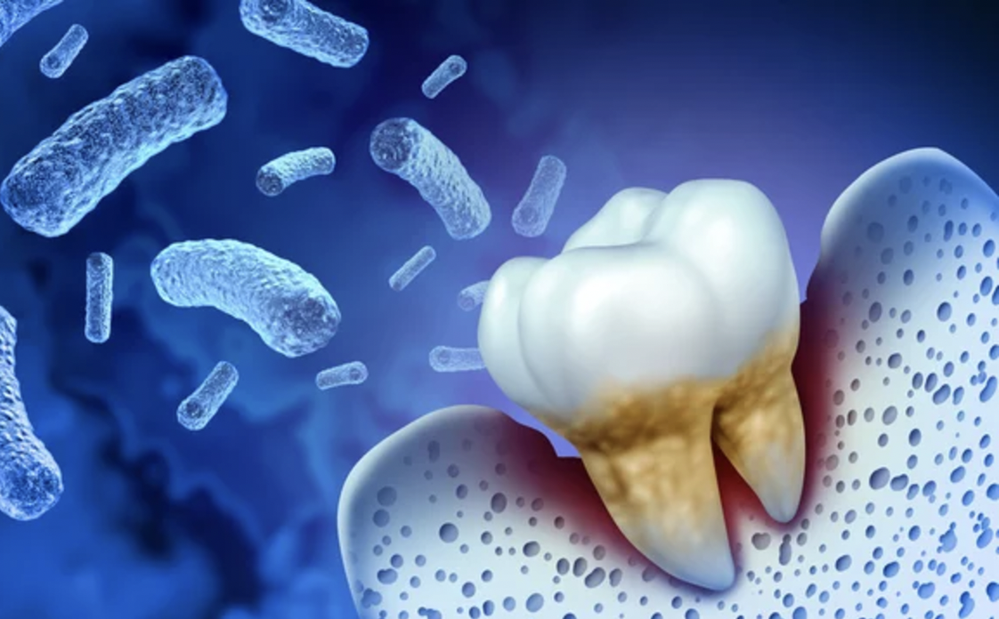 歯槽膿漏について知ろう｜歯周病との違いとは？ 画像