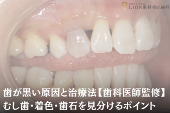 歯が黒い原因と治療法【歯科医師監修】むし歯・着色・歯石を見分けるポイント