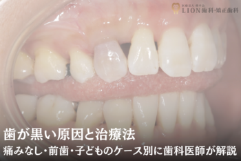 歯が黒い原因と治療法|痛みなし・前歯・子どものケース別に歯科医師が解説