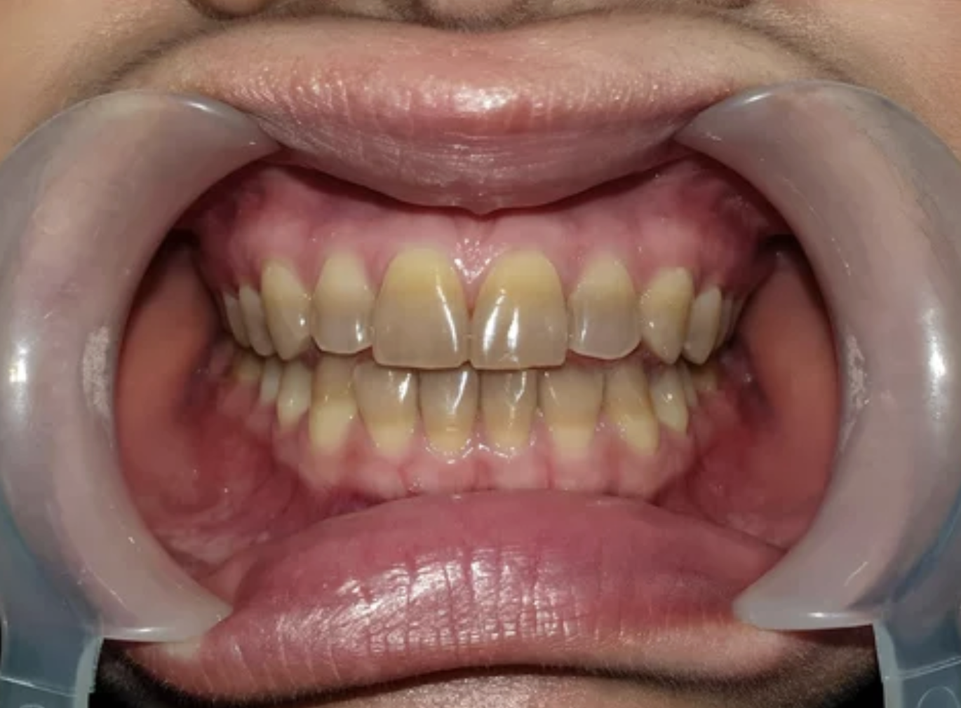 テトラサイクリン歯とは？ 原因・特徴・治療法を詳しく解説 画像