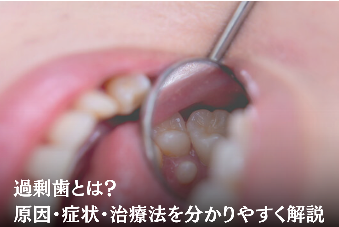 過剰歯とは|原因・症状・治療法を分かりやすく解説 | LION歯科・矯正歯科
