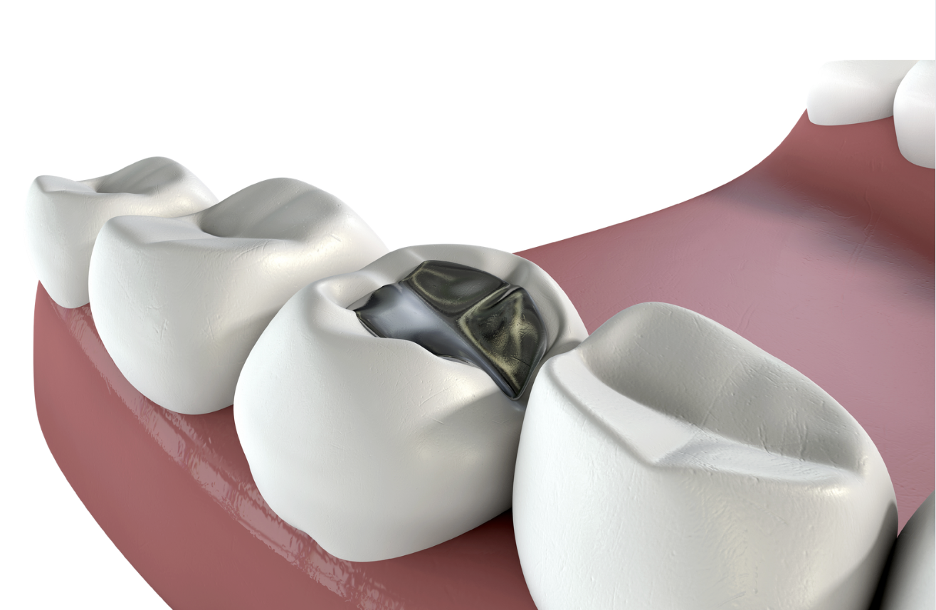 歯科における金属アレルギーとは？ 金属を使わない歯科治療 画像