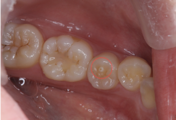 中心結節症例写真