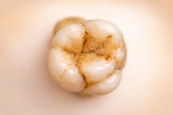 カラベリー結節のイメージ画