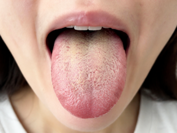 舌苔が気になる女性の口腔内イメージ