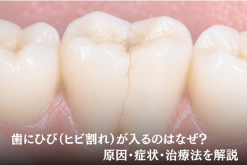 歯にひび(ヒビ割れ)が入るのはなぜ?原因・症状・治療法を解説